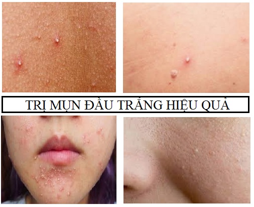 Trị mụn đầu trắng