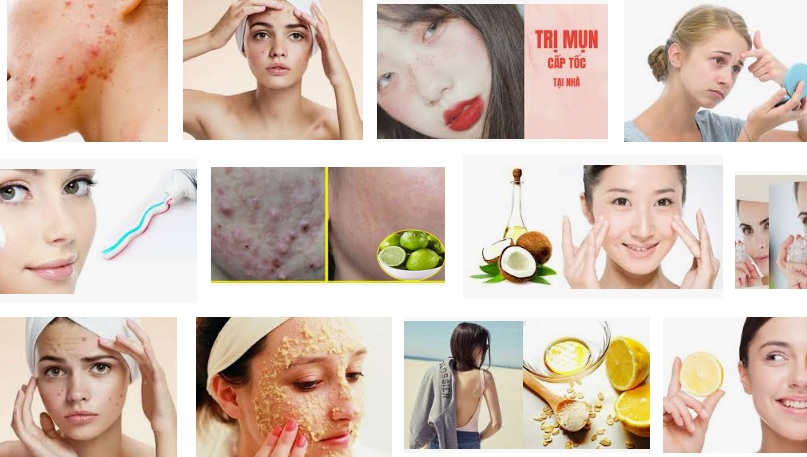 Cách trị mụn tại nhà hiệu quả